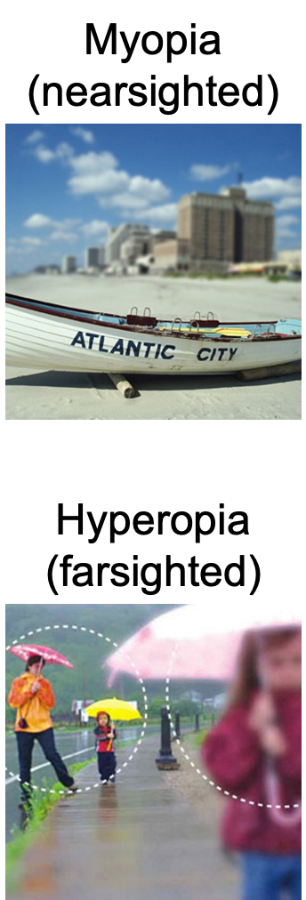 <p>center of the visual field and contains no rods, but a high density of cones</p><ul><li><p><strong>Nearsighted</strong>: long eyeballs/rounded corneas that focus light in <em>front</em> retina</p></li><li><p><strong>Farsighted</strong>: short eyeballs/flat corneas that focus light <em>behind</em> retina</p></li></ul><p></p>