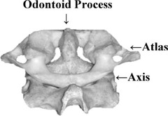 <p>pivot joint</p>