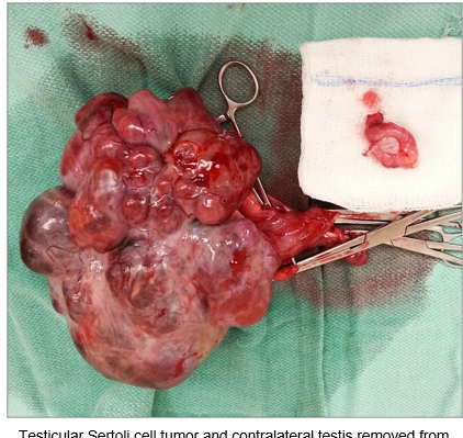 <p><span>●Is <strong>hereditary</strong> (mechanism unknown)</span></p><p><span>●<strong>Retained testes are small</strong>, with a comparatively large epididymis</span></p><p><span>●Retained testes are <strong>more likely to develop tumors</strong>, particularly Sertoli cell tumors and seminomas</span></p><p><span>●Retained, neoplastic testes <strong>more susceptible to torsion</strong></span></p>