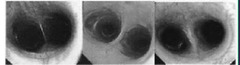 <p>You can score the septum of the bronchi (aka the bronchial bifurcations). What is the scale?</p>