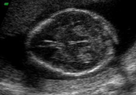 <p>fetal head with normal BPD and narrow frontal diameter</p><ul><li><p>associated with <strong>trisomy 18</strong></p></li></ul><p></p>