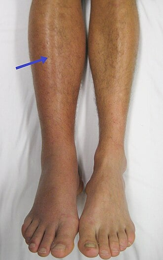 <p>Thrombus formation in deep veins, MC in the lower extremities </p><p>-Virchow’s triad → stasis + endothelial injury + hypercoagulability </p><p>-RF → prolonged immobility, surgery, malignancy, pregnancy, OCP/HRT use, thrombophilia, hx of VTE</p><p>-Presentation: unilateral leg swelling, pain, warmth, erythema, Homans sign </p><p>-Dx: duplex ultrasonography, Wells DVT score </p><p>-Tx: DOACs first-line, LMWH if malignancy related, IVC filter if contraindication </p>
