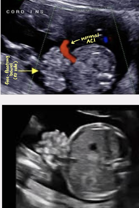 <ul><li><p><span style="color: red;">right paraumbilical defect</span> of abdominal wall</p><ul><li><p>rarely a left-side defect</p></li></ul></li><li><p>normal fetal cord insertion</p></li><li><p><span style="color: red;">free-floating herniated bowel</span></p><ul><li><p>other organs may be involved</p></li><li><p>herniated bowel may be dilated or thick-walled; may be obstructed</p></li></ul></li></ul><p></p>