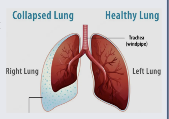 <p><span style="background-color: transparent;">Pneumothorax parts</span></p>