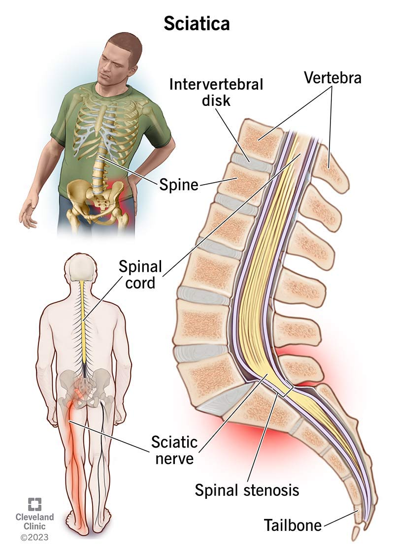 <p>Pain that <strong>radiates along the sciatic nerve</strong>, usually from the <strong>lower back down the leg</strong>.</p>