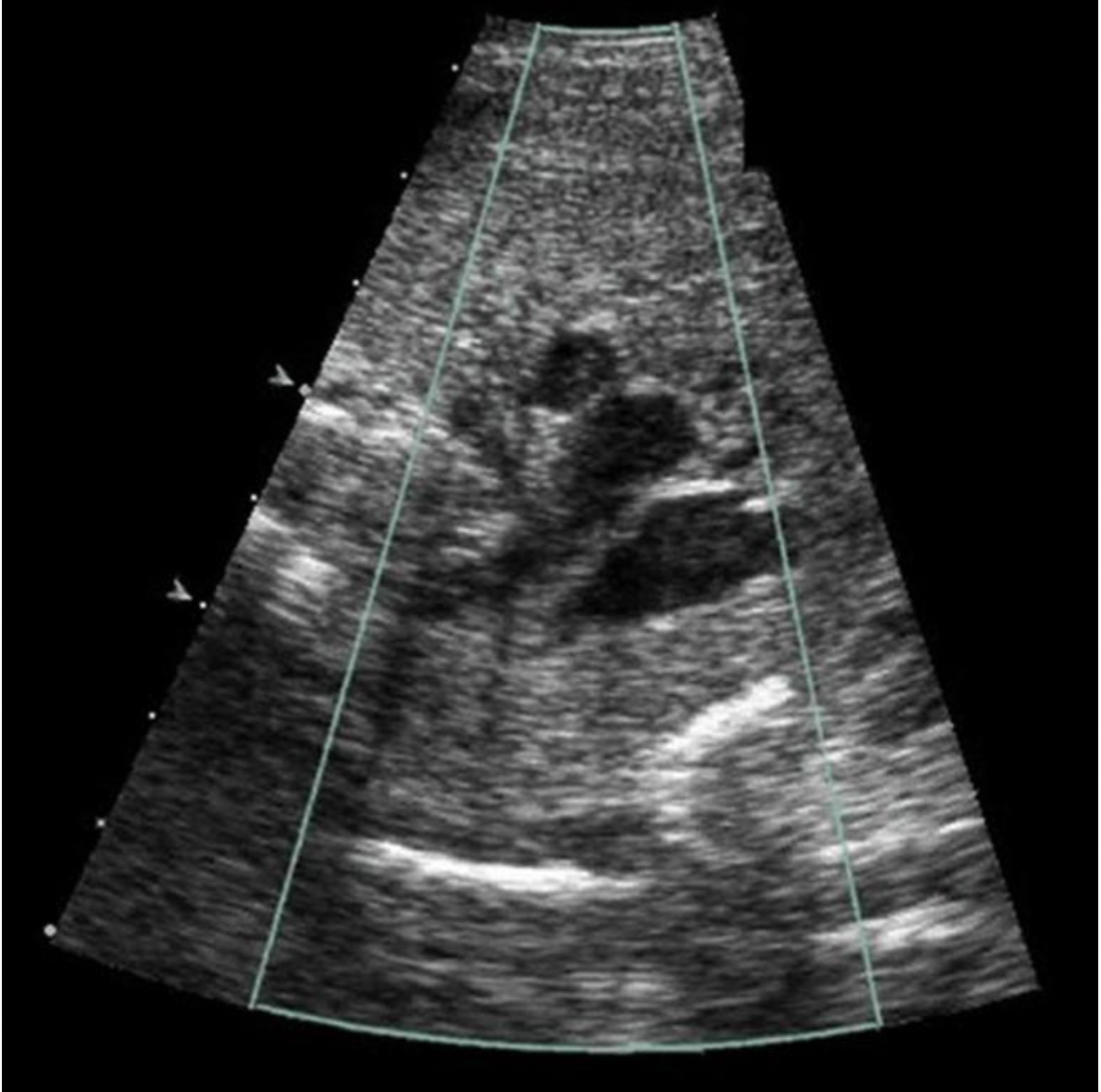 <p>Click on the aorta on the three vessel view</p>