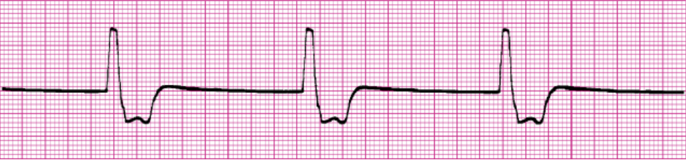 <ul><li><p><span style="background-color: transparent;">Happens after junctional rhythm</span></p></li><li><p><span style="background-color: transparent;">Failure of SA and node</span></p></li><li><p><span style="background-color: transparent;">Intrinsic rate of 20-40 bpm</span></p></li><li><p><span style="background-color: transparent;">Absent P waves</span></p></li><li><p><span>Wide QRS</span></p></li><li><p><span style="background-color: transparent;">Tx</span></p><ul><li><p><span style="background-color: transparent;">Determine cause</span></p></li><li><p><span style="background-color: transparent;">No electricity&nbsp;</span></p></li><li><p><span style="background-color: transparent;">Pacemaker placement</span></p></li></ul></li></ul><p></p>