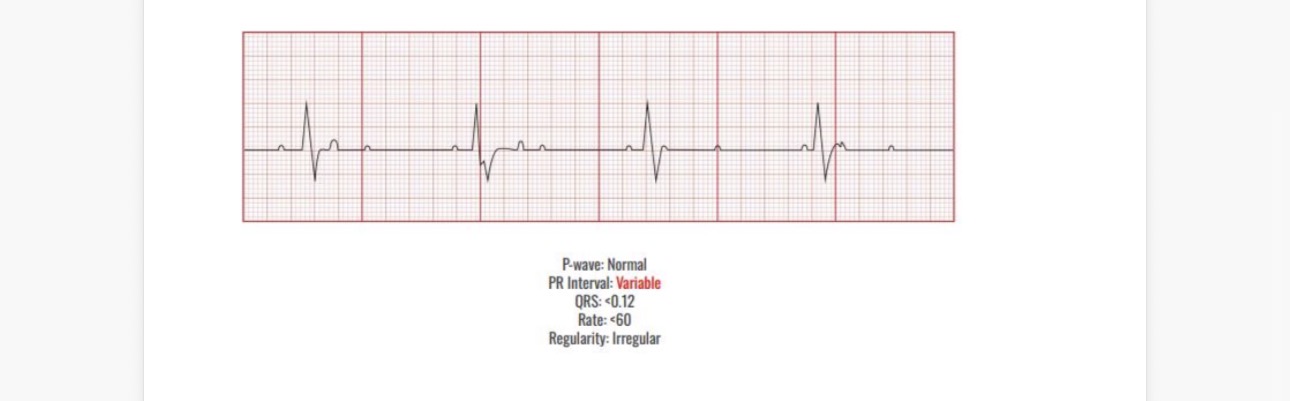 <p>Causes </p><p>Damage to the heart</p><p>Mi</p><p>Heart valve disease</p><p>Rheumatic fever</p><p>Sarcoidosis</p><p></p><p></p><p>Interventions</p><p>Pacing </p>