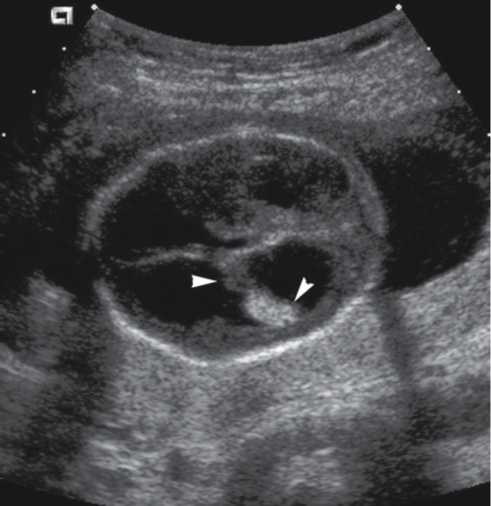 <p>Atrium of LV meas >10mm</p><p>Atrial meas >15mm is considered moderate to marked ventriculomegaly</p><p>Dangling choroid sign </p><p>Dilation of any part of ventricular system </p>