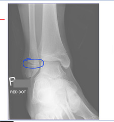 <p>Wide growth plate and soft tissue swelling</p>