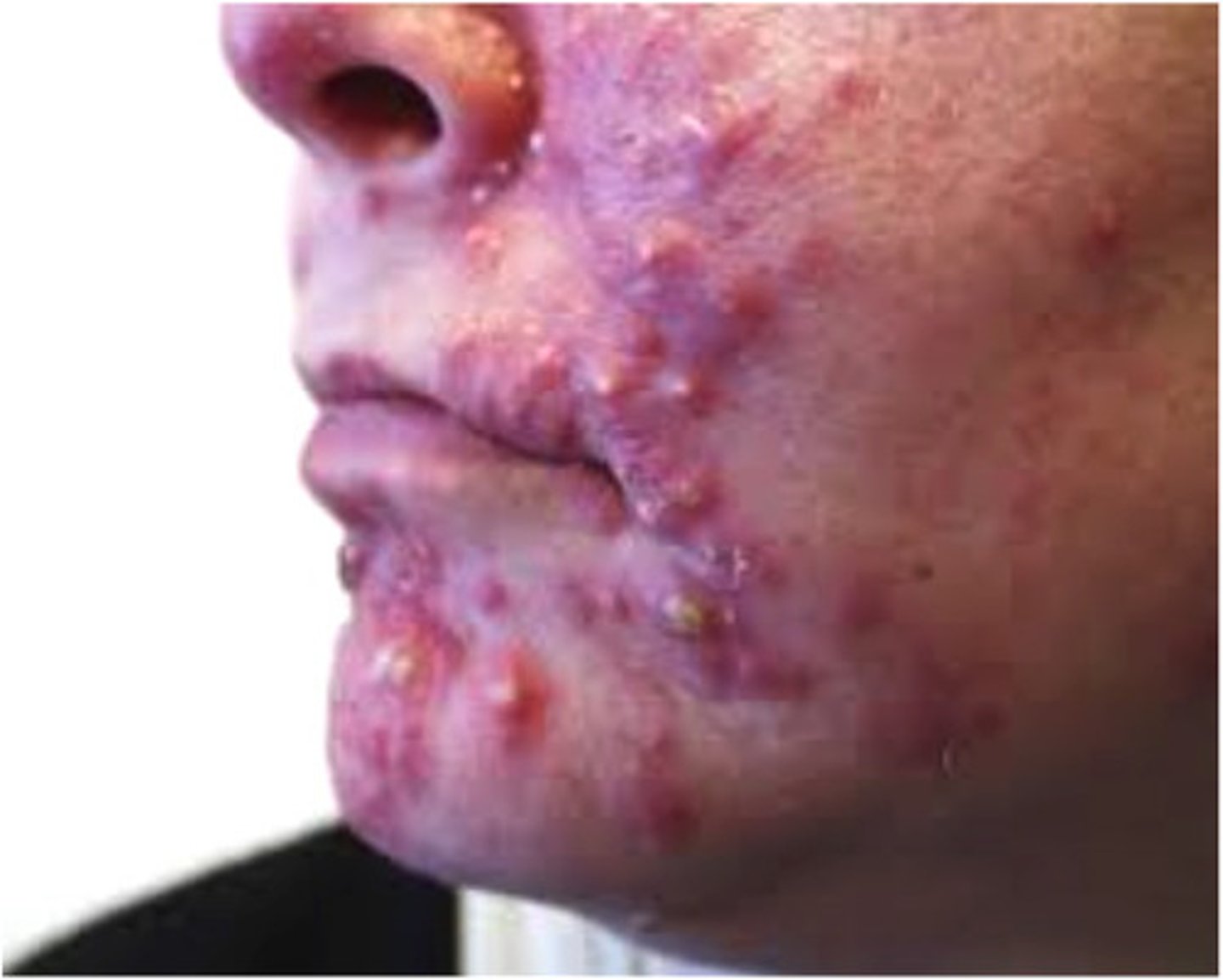 <p>Technical term for acne bacteria</p>