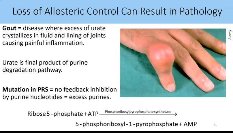 <p>disease where excess of urate crystallizes in fluid and linig of joints causing painful inflammation</p><ul><li><p>urate is final product of purine degradation pathway</p></li><li><p>mutation in PRS = no feedback inhinition by purine nucleotides = excess purienes</p></li></ul><p></p>