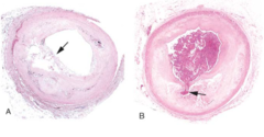 <p>layers of fatty material (plaques) build up inside the coronary arteries, narrowing them.</p>
