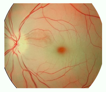 <p>Sudden blockage of the central retinal artery, cutting off blood supply to the retina.</p><p><strong>Signs:</strong> </p><ul><li><p>Pale retina, </p></li><li><p>cherry red spot at macular, </p></li><li><p>attenuated arterioles (white/yellow spots), </p></li><li><p>“boxcarring” of blood columns (discontinuous columns of red blood cells)</p></li></ul><p><strong>Symptoms:</strong> </p><ul><li><p>Sudden, painless vision loss, often NLP or just hand movements</p></li></ul><p></p>