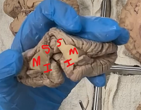 <p>S: superior peduncle</p><p>M: middle peduncle</p><p>I: inferior peduncle </p>