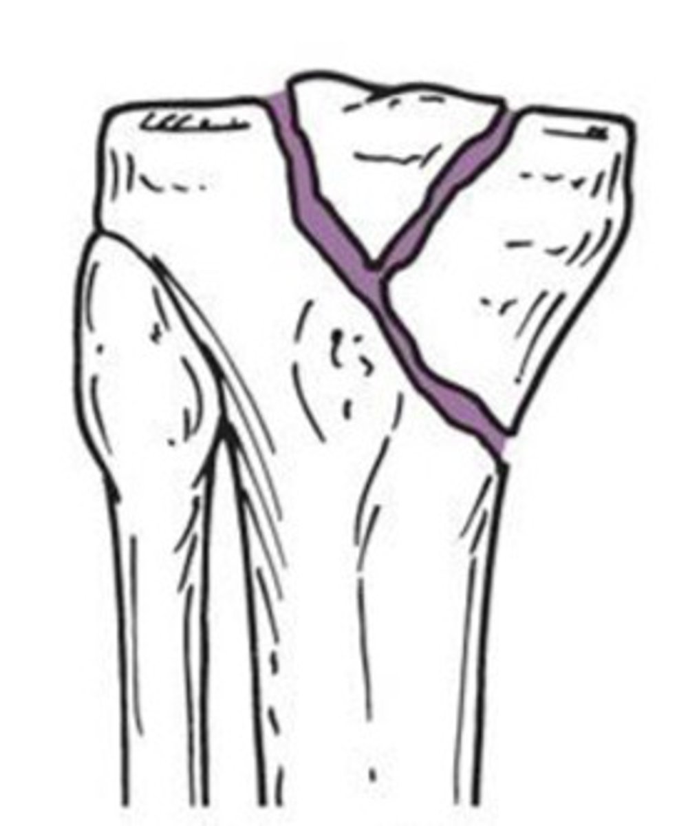 <p>What type of fracture does this show?</p>
