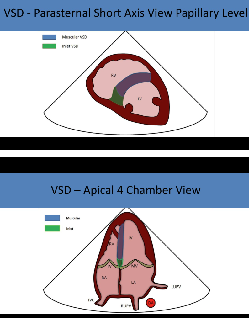 <p>in posterior septum, near posterior leaflet of tricuspid valve </p>