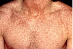 <p>a viral infection characterized by a low-grade fever, swollen glands, inflamed eyes, and a fine, pink rash</p>