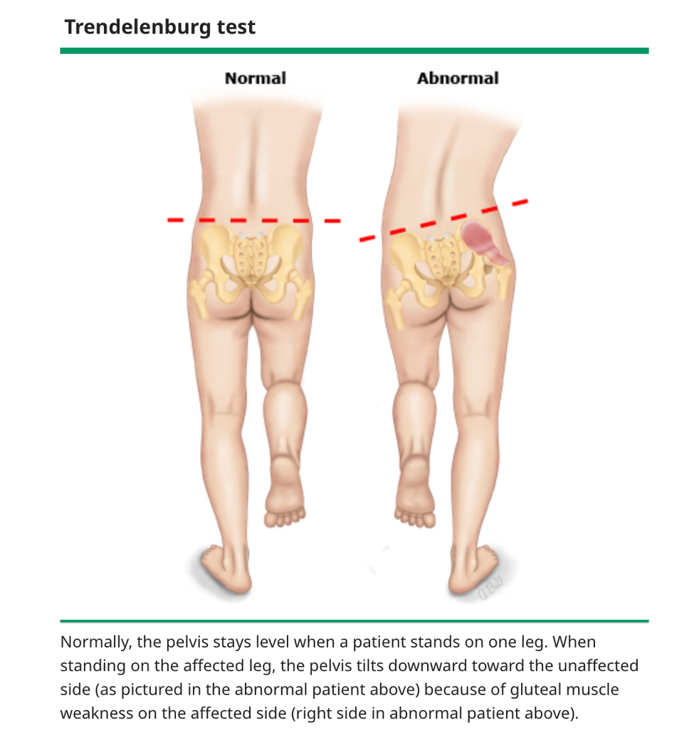 <p>A clinical finding where the pelvis drops on the unaffected side when standing on one leg, indicating weakness of the hip abductors (gluteus medius/minimus) on the weight-bearing side</p>