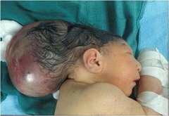 <p>a congenital herniation of brain tissue through a gap in the skull. Similar to spina bifida, but due to a failure of the cranial end of the neural tube to close.</p>