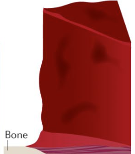 <p>Fourth degree burn?</p>