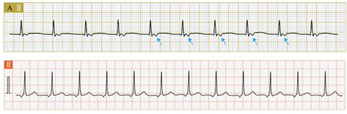 <p>basically the 60-100bpm version of junctional escape rhythms</p>