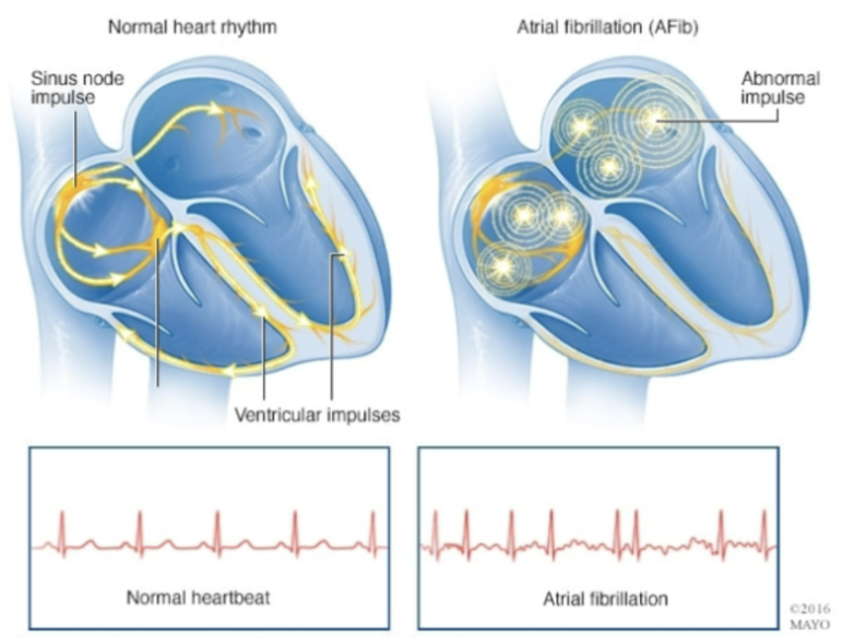 <p>No regular P waves, and irregular signals lead to irregular rhythm on the ECG (tachycardia) </p>