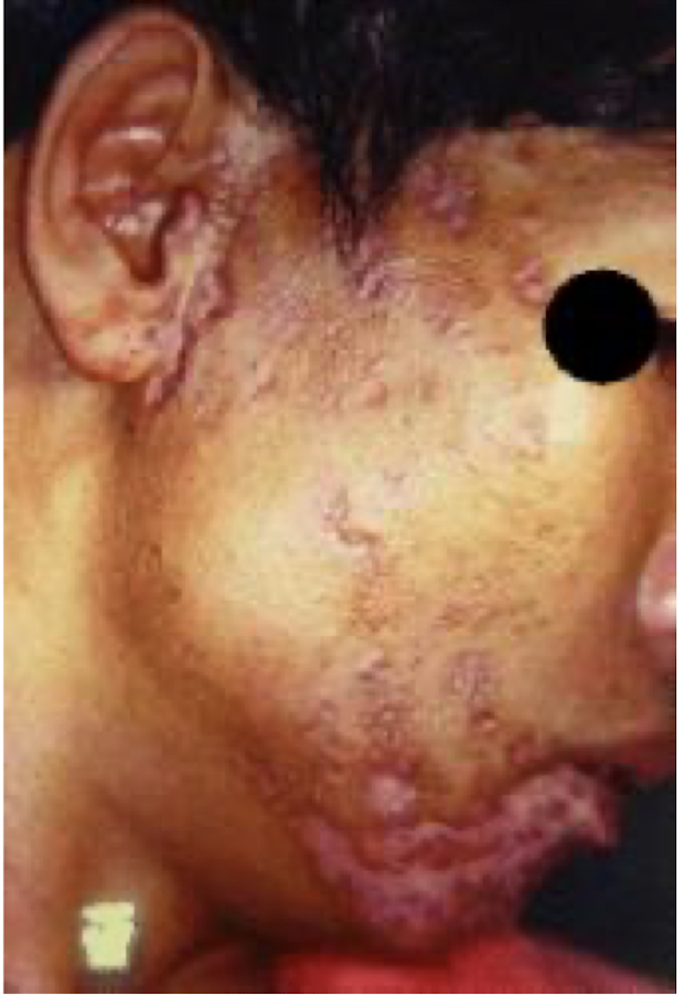<p>what are these lesions associated with</p>