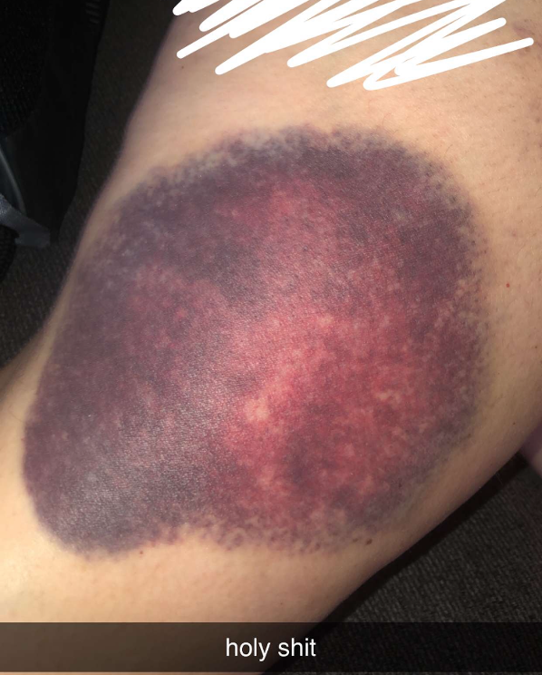 <p>aka bruising: mass of clotted blood showing through skin</p>