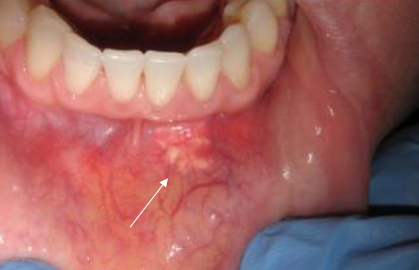 <p>becoming more common; hyaluronic acid (juvederm) or poly-lactic acid (sculptra); usually asymptomatic though pts may complain of a “bump”; some cases can have an allergic reaction; brusing, erythema, itching </p>