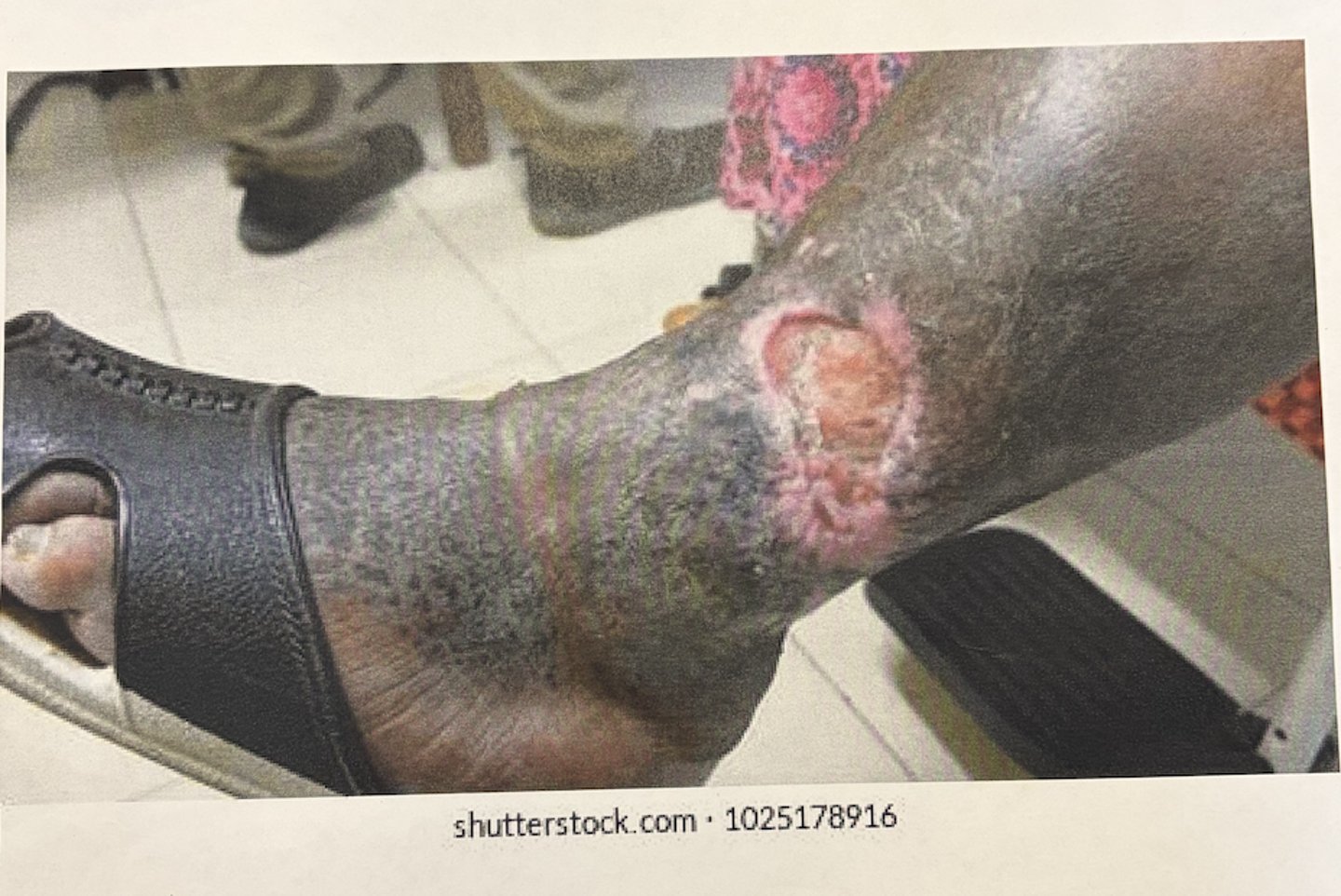 <p>how would you care for this wound?</p>