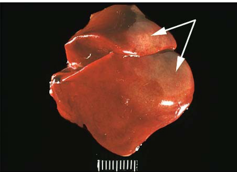 <p>coagulation necrosis</p>