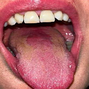 <p>appears to be a<span style="color: red;"> raw surface</span>, such as that seen with the<span style="color: red;"> loss of filiform papillae</span> of the tongue</p>