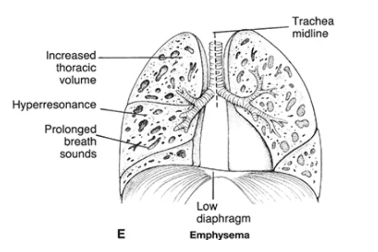 <p>type of COPD characterized by destruction of alveolar walls leading to the loss of elastic recoil + air trapping</p><ul><li><p>patients rely on hypoxic drive in advanced disease → important for oxygen titration</p></li></ul><p></p>
