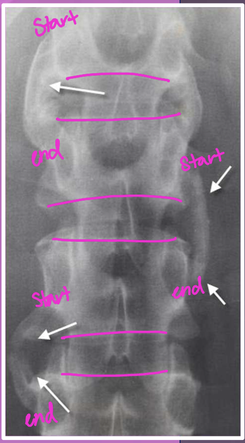 <p>asymmetrical, thick, bulky nonmarginal (above and below endplates)</p>