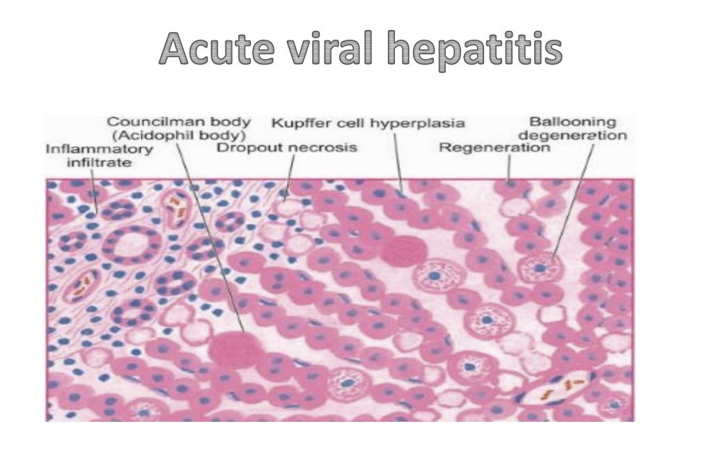 <p>Councilman body (Acidophil body), Kupffer cell hyperplasia, Inflammatory infiltrate, Dropout necrosis, Regeneration, Ballooning degeneration</p>