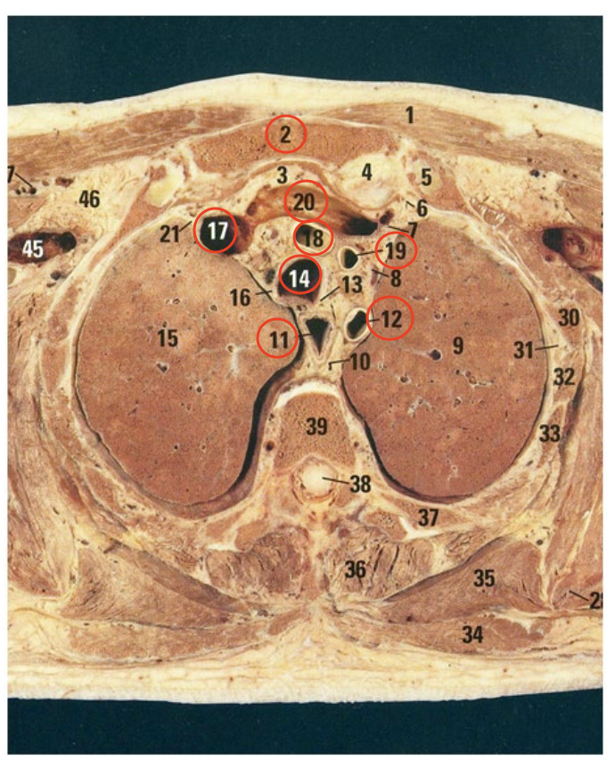 <ol start="2"><li><p>sternum</p></li></ol><ol start="11"><li><p class="p1">œsophage</p></li></ol><p class="p1">12,18,19. gerbe aortique</p><ol start="14"><li><p class="p1">trachée</p></li></ol><p class="p1">17. veine brachiocéphalique droite</p><p class="p1">20. veine brachiocéphalique gauche</p>