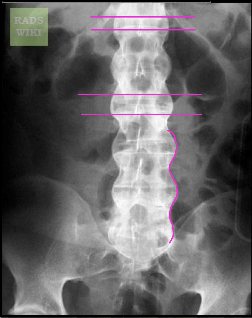 <p>symmetrical, thin, gracile/fragile marginal</p>