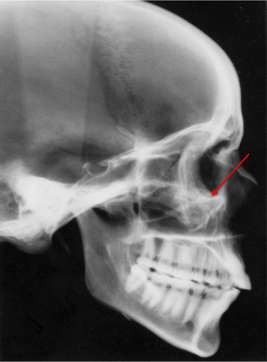 <p>which anatomical landmark:</p><p>- Lowest point of the floor of the orbit</p><p>- Most inferior point of the external border of the orbital cavity</p>