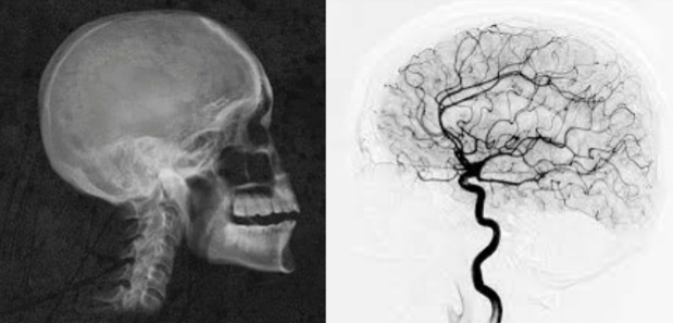 <p>mostly useless on brain, not enough contrast between structures, cerebral angiogram uses x-ray plus dues om arteries for circulatory system investigations</p>