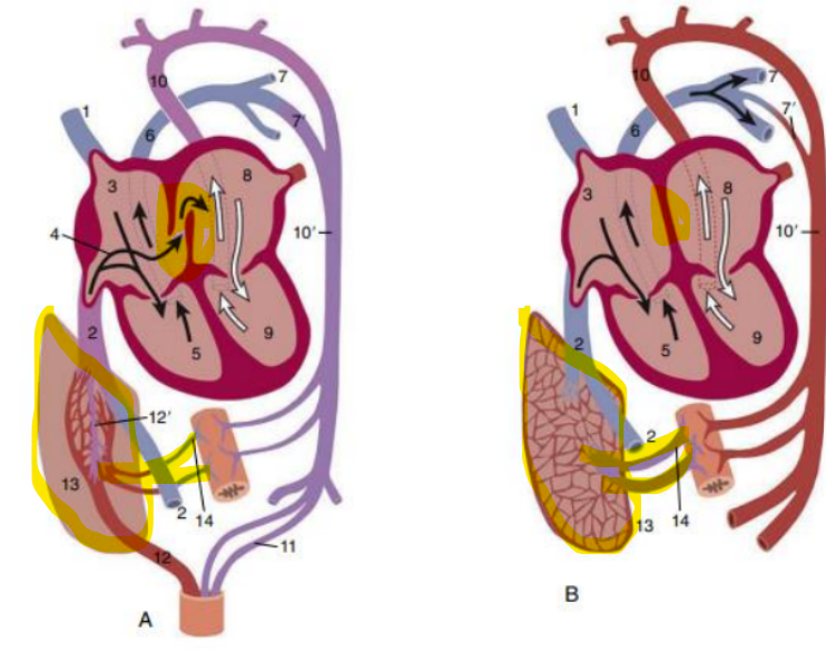 <p><strong>Foramen ovale closes</strong></p><p>Increased venous return from lungs to left atrium</p><p>Reduced venous flow from placenta to right atrium</p><p>Pressure in left > right, forces septum primum against</p><p></p><p><strong>septum secundum</strong></p><p>Anatomical closure takes up to 1 year in most species</p><p></p><p>Non-functional vessels regress, become ligaments</p><p>E.g. umbilical arteries -r<span style="color: purple;">ound ligament; ligamentum arteriosu</span>m</p><p></p><p>Compression of the thorax squeezes fluid out of the lungs</p><p></p><p><strong>Lungs inflate</strong></p><p>Pulmonary <span style="color: purple;">vascular resistance becomes lower</span></p>
