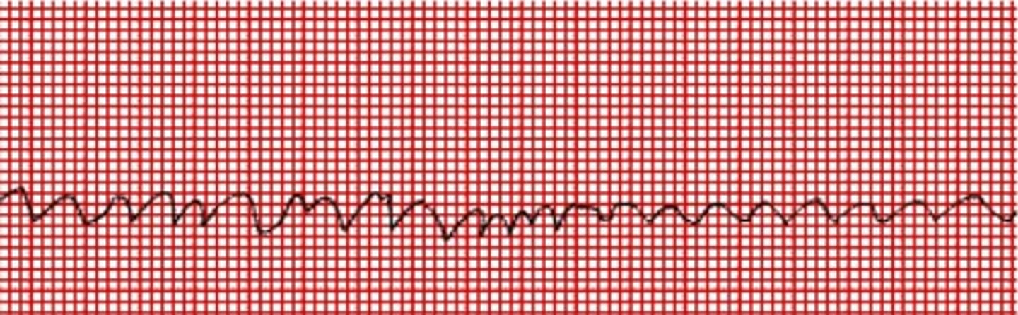 <p>howd yk that is v fib</p>