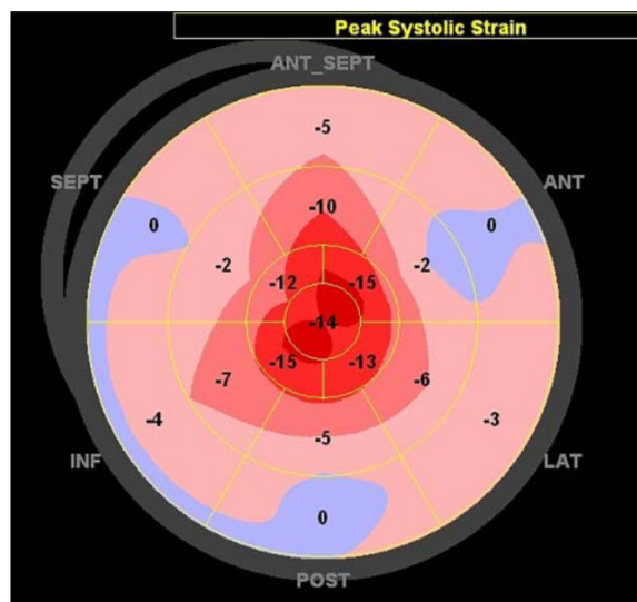 <p>The basal and midventricular segments have reduced strain, while the apex remains relatively preserved. - APEX IS AFFECTED LAST</p><p>( THATS WHY WE GET A CHERRY ON TOP)  (mechanism is idopathtic)</p><p>(differental from HCM blue berry)</p>