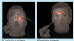 <p>absense of a glow on one or both sides suggest a thickened mucosa or secretions in the sinus, but it may also result from develpmentsal absence of one or both sinuses (frontal). See text for description of methods for transillumination of sinuses</p>