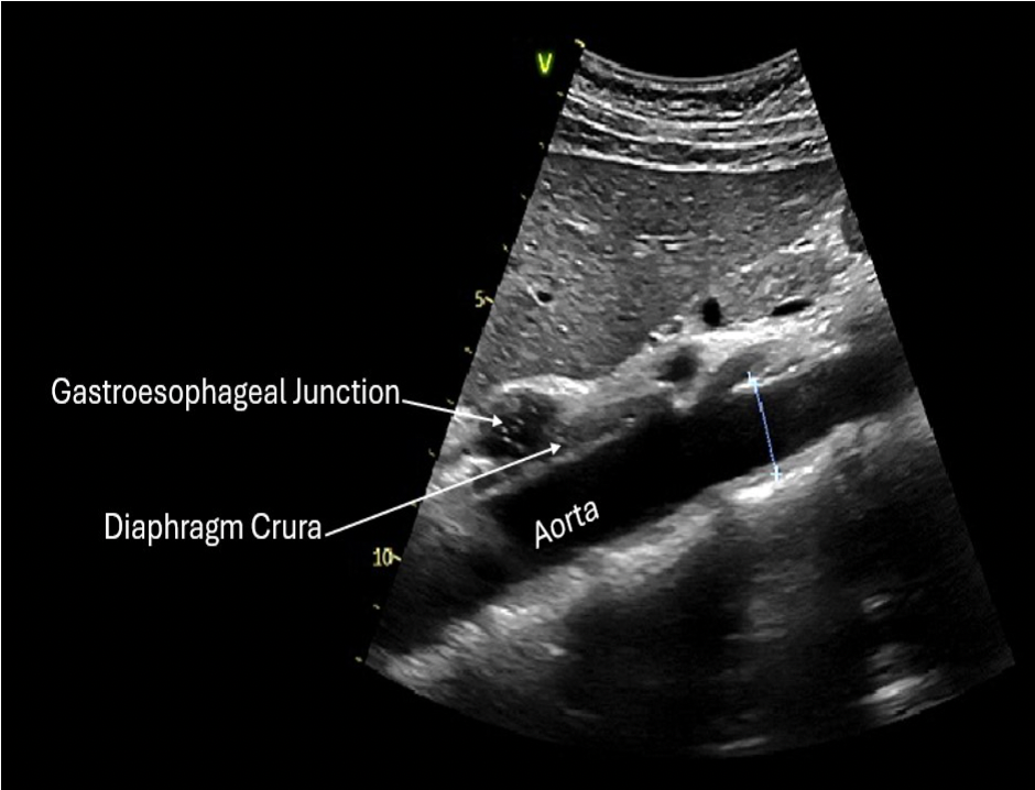 <p>A. longitudinal</p>
