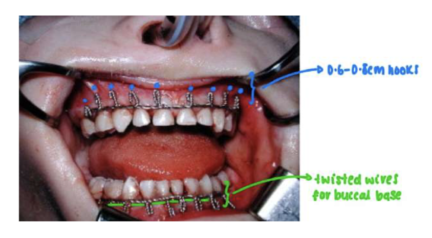 <p>0.4mm thick, 25cm long wire (2 wires)</p><p>loop the wire around most distal mandibular tooth</p><p>both ends are twisted together to form a solid buccal base</p><p>connect the twisted wires from the left to the right side to make 1 structure in the midline</p><p>tie the ligatures in the cervical region of each tooth</p><p></p>