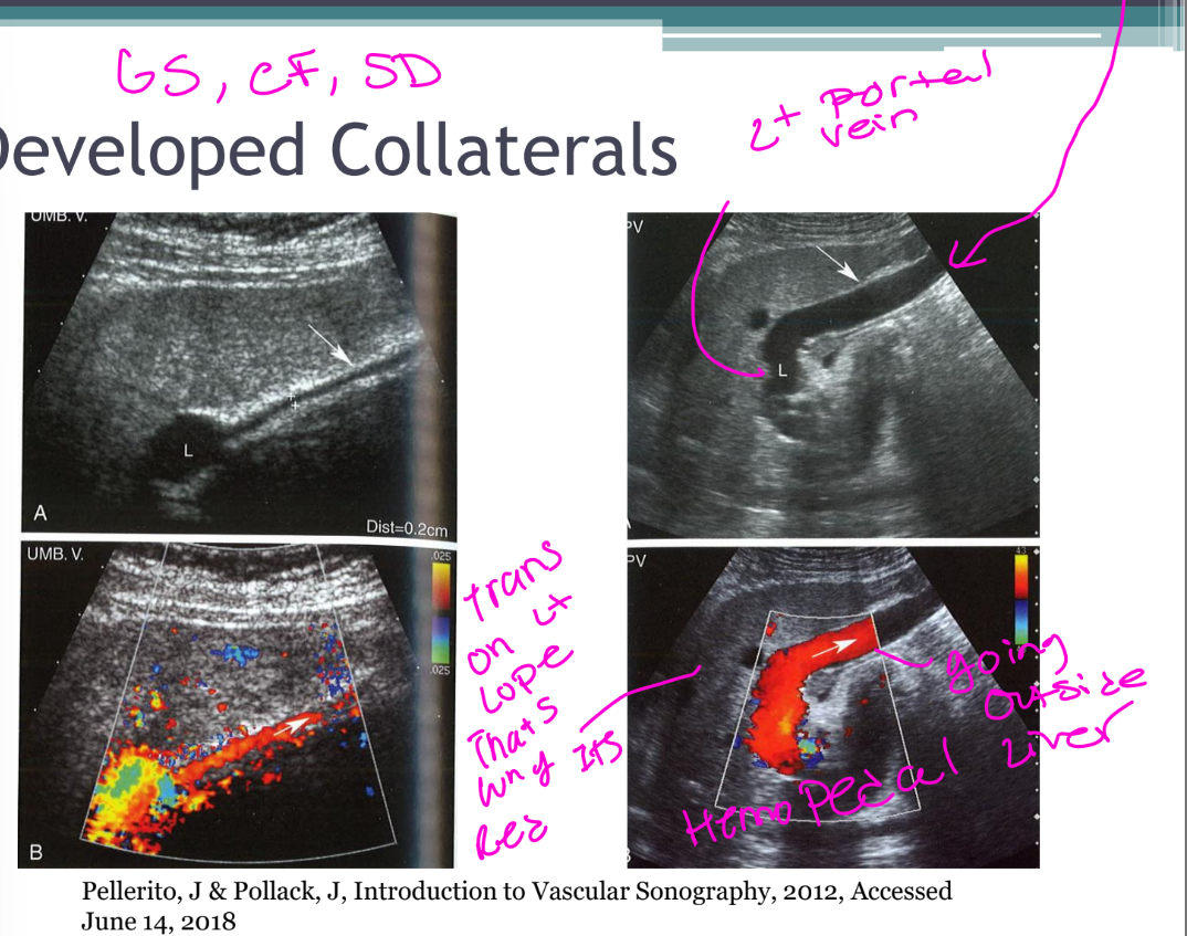 <ul><li><p>It is a remnant of fetal circulation.</p></li><li><p>It is located in the ligamentum teres.</p></li><li><p>It courses from the umbilicus to the anterior left portal vein.</p></li><li><p>It normally measures <strong><3 mm</strong>.</p></li></ul><p></p>