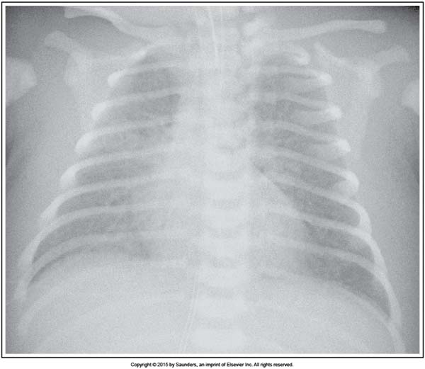 <p><span>caused by a lack of x-ray photons reaching the image receptor</span></p>