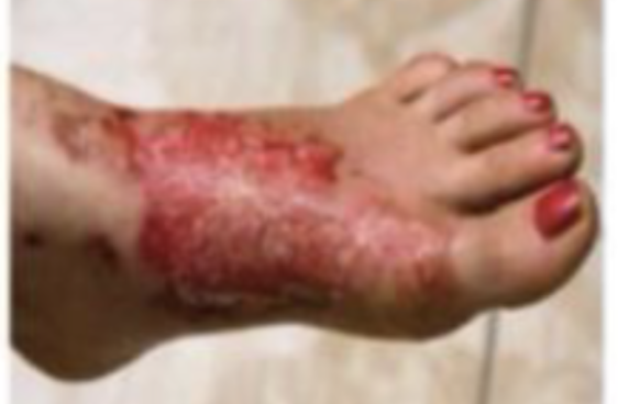 <p>What degree is this burn?</p>