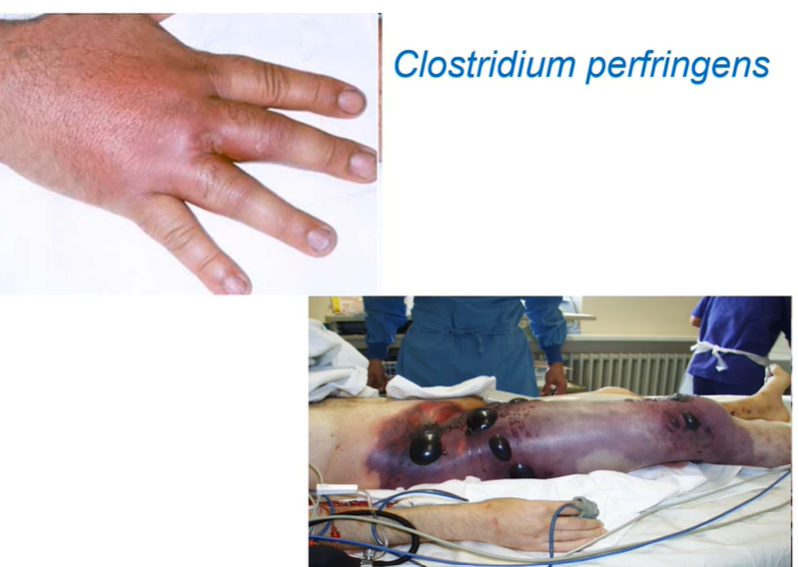 <p>Độc tố alpha của clostridium perfrigen</p>
